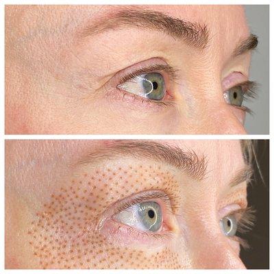 Plasma Eye Lift - immediately after