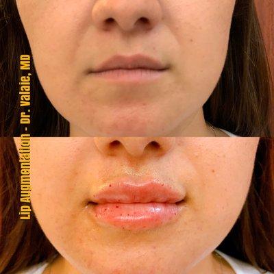 Lip Augmentation - Dr.Valaie, MD