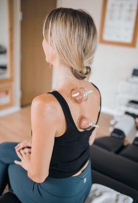 Cupping for shoulder pain.