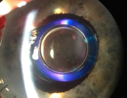 Dr. Matthew Kim's Implantable Miniature Telescope patient. This patient has Advanced Macular Degeneration.