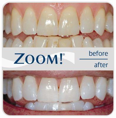 Zoom! In Office Whitening