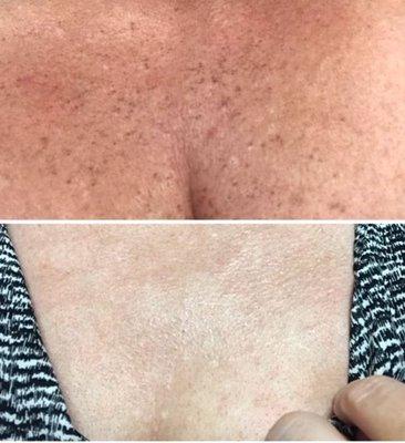 Before and after three IPL treatments