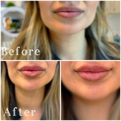 Indulge in lip love with the lip filler you desire!