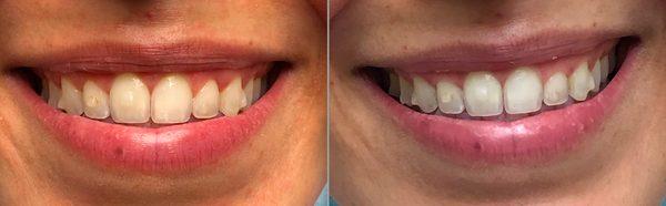 "Gummy Smile "before and after Gingivectomy