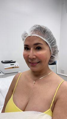 After Microneedling PRP