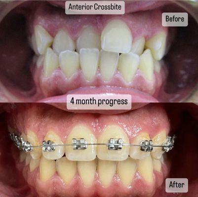 Before/after