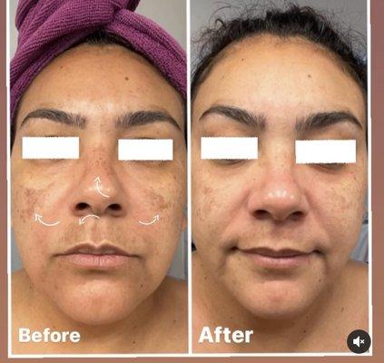 Hyperpigmentation significantly reduced after chemical peel