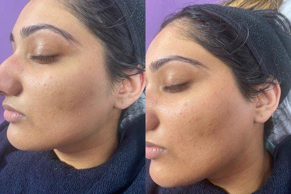 Derma plane facial before and after