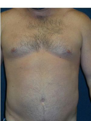 Male, 36 yr old AFTER LIPOSUCTION ABDOMEN