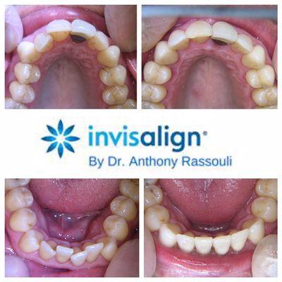 Let your smile do the talking after Invisalign and Dr. A. do their magic. Call us today for your complimentary consultation: (714) 842-5561