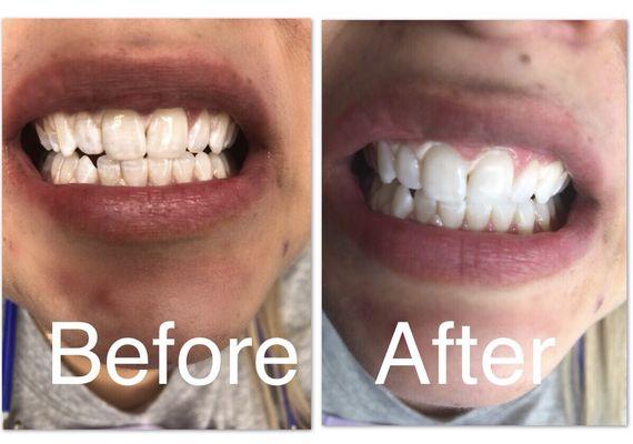 Teeth Whitening Restoration