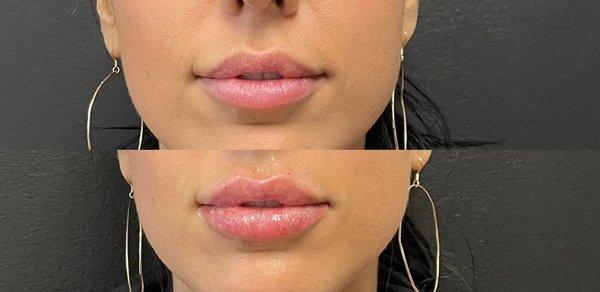 Before and After Juvéderm Lips!