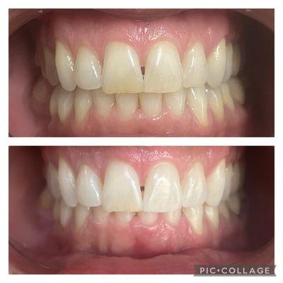 Teeth Whitening 30mins