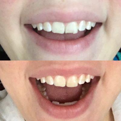 Before and after chipped tooth fixed