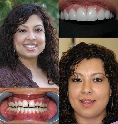 8 veneers