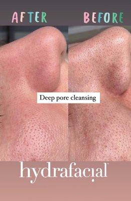 Deep pore cleansing