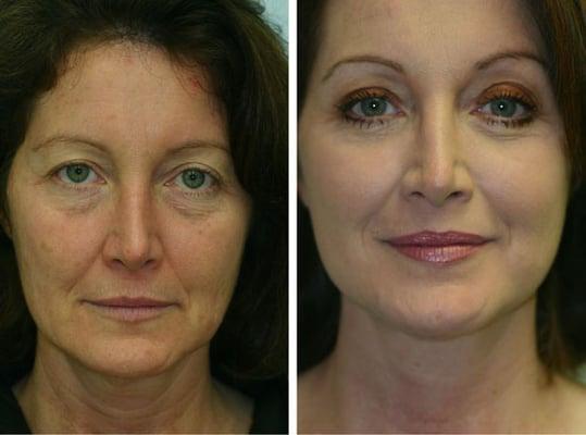 Face lift, brow lift