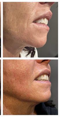 Sculptra before and after