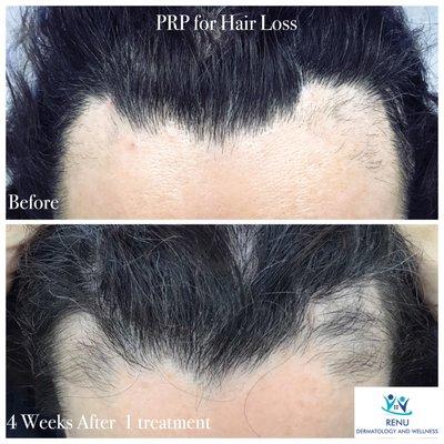 Amazing and natural PRP (Platelet Rich Plasma) regrows hair. This is a safe and effective therapy for hair loss. Call us now