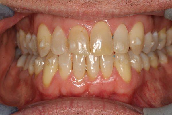 Crowding is resolved with Invisalign and the gums and teeth are healthier and more attractive.