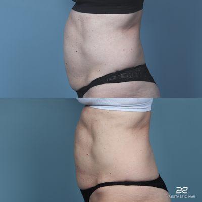 Coolsculpting Elite to the abdomen