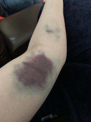 Left arm after donating