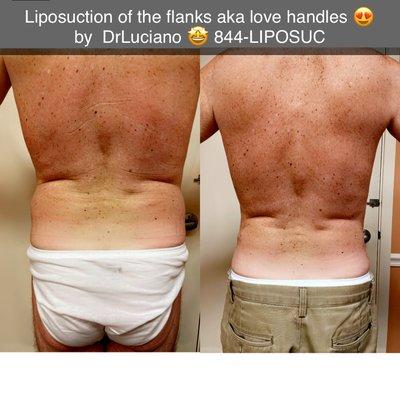 Male love handles Lipo  with local anesthesia!