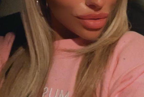 Beautiful lip Injections by Dr. Alessi