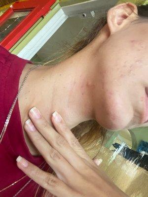 My skin with acne, it affected my self-esteem