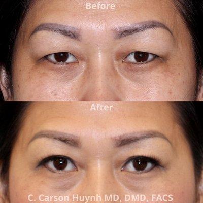 Anchoring Blepharoplasty