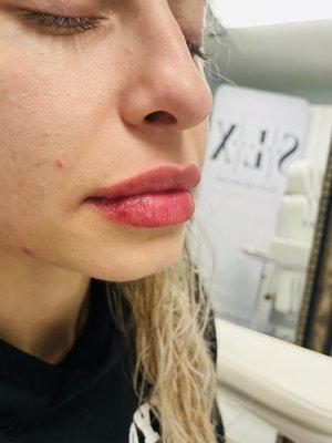 After side profile lip injections