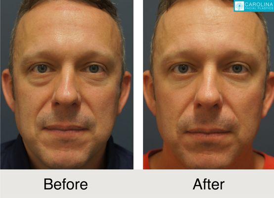 Before and after blepharoplasty