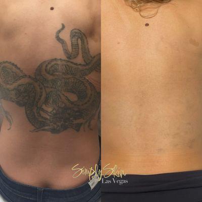 Tattoo Removal Before/After