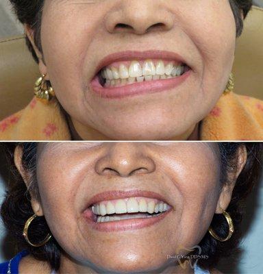 Patient very happy with her new veneers!