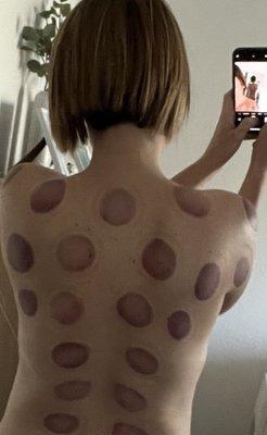 After my cupping therapy.