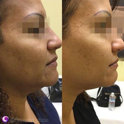 2 treatments Kybella for double chin