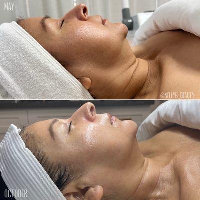 Before and after DMK Enzyme Therapy for age management and brightening