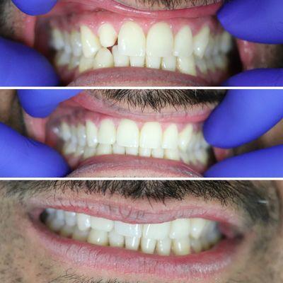 Missing a crown? A perfect color match to make a natural crown look like a normal tooth. Work done by Dr. Kevin Jan.