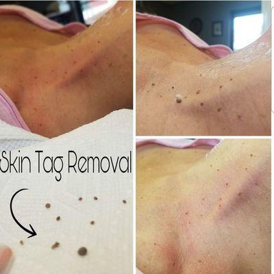 skin tag removal