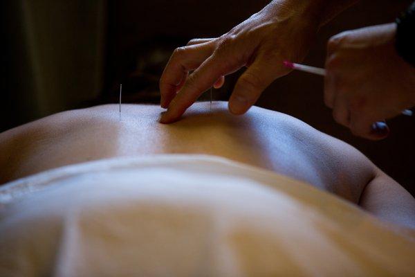 CIS uses Boutique Acupuncture for pain relief alternatives.