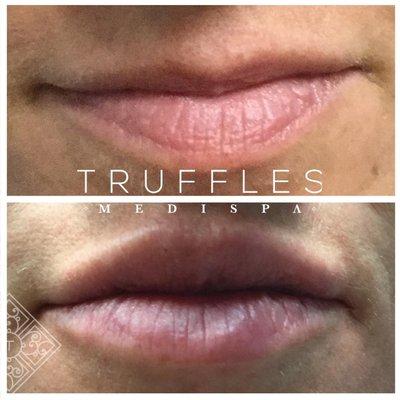 juvederm lip filler before and after