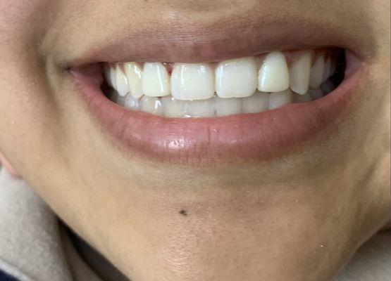 my daughter after composite veneers