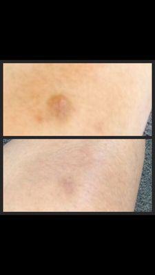 Spot treatment with ipl