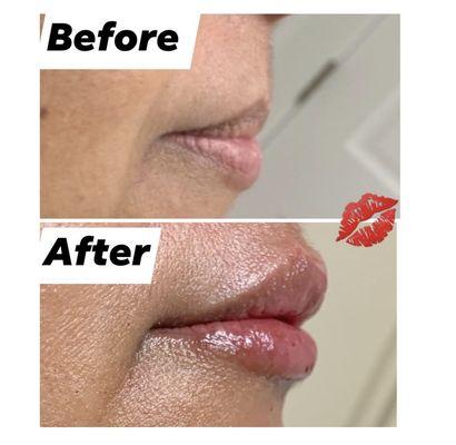 Lip plump with juvederm