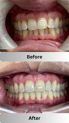 Before and After photos from Invisalign