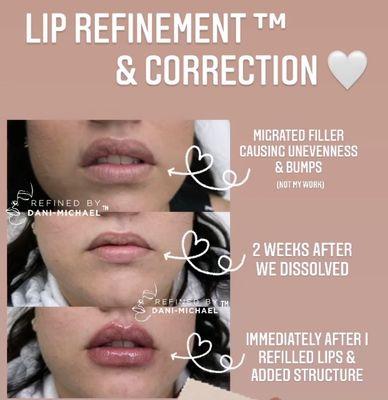 My lip injection journey summed up