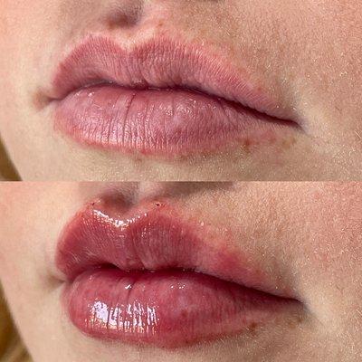 Another angle of the client that we used 1ml of Versa to augment this clients lips. She wanted to enhance her already beautiful lips.