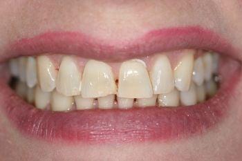 Porcelain Veneers (before)