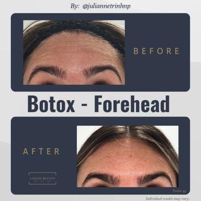 Botox Forehead by Julianne Trinh NP reduce wrinkles