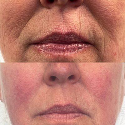 Before and after one rejuvapen micro needling skin tightening and skin resurfacing treatment.